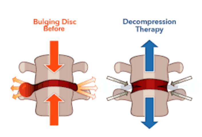 Spinal Decompression Therapy Explained Diversified Health Clinic