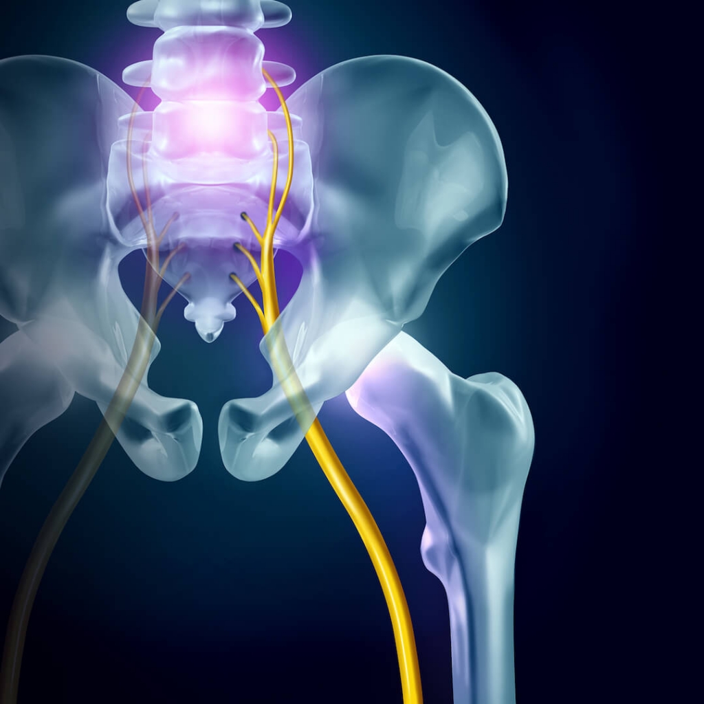 Nerve Pain With Sciatica What It Is And How We Approach Sciatic